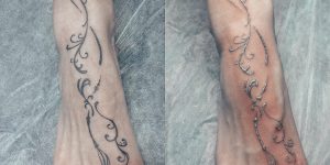 Пример лазерного удаления татуировки